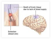 Možganska kap: strdek privede do odmrtja možganskega tkiva