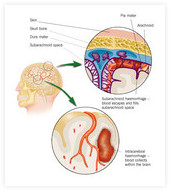 Krvavitev med možganske ovojnice (subarahnoidalno) ali v možganovino vodita v možgansko kap.