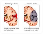 Levo: možganska kap zaradi krvavitve. Desno: možganska kap zaradi strdka.
